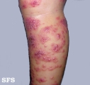 eczema herpeticum