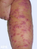 eczema herpeticum