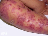 eczema herpeticum
