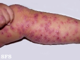 eczema herpeticum