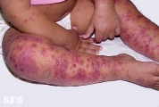 eczema herpeticum
