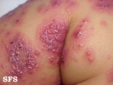 eczema herpeticum