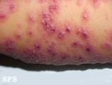 eczema herpeticum
