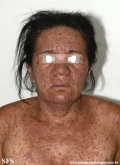 eczema herpeticum