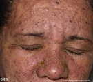 eczema herpeticum