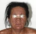 eczema herpeticum