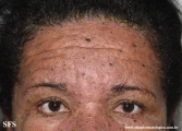 eczema herpeticum
