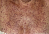 eczema herpeticum