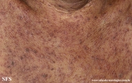 eczema herpeticum