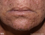 eczema herpeticum