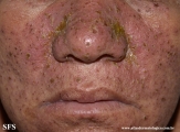 eczema herpeticum