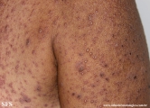eczema herpeticum