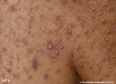eczema herpeticum