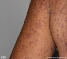eczema herpeticum