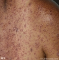 eczema herpeticum