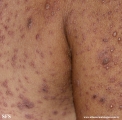 eczema herpeticum