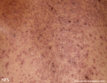 eczema herpeticum