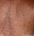 eczema herpeticum