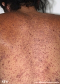 eczema herpeticum