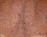 eczema herpeticum