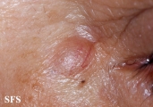 trichoblastoma