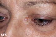 trichoblastoma
