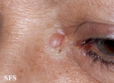 trichoblastoma