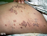 porokeratosis-segmental porokeratosis