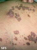 porokeratosis-segmental porokeratosis
