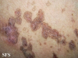 porokeratosis-segmental porokeratosis
