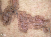 porokeratosis-segmental porokeratosis