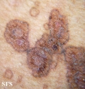 porokeratosis-segmental porokeratosis