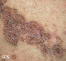 porokeratosis-segmental porokeratosis