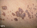 porokeratosis-segmental porokeratosis