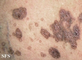 porokeratosis-segmental porokeratosis