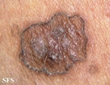 porokeratosis-segmental porokeratosis