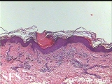 porokeratosis-segmental porokeratosis