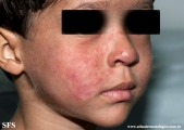 tinea facei
