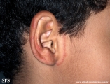 tinea facei