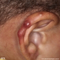 tinea facei