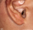 tinea facei