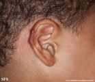 tinea facei