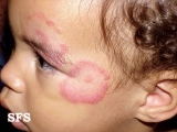 tinea facei