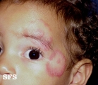 tinea facei