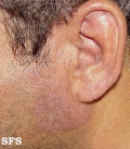 tinea facei
