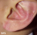 tinea facei