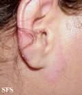 tinea facei