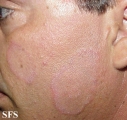 tinea facei