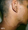 tinea facei