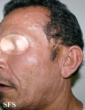 tinea facei